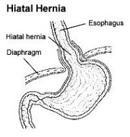 Hiatal-Hernia
