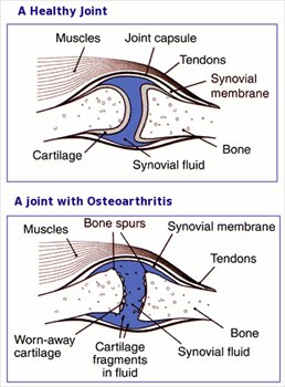 Osteoarthritis