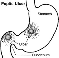 Peptic-Ulcer