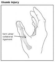 Thumb-injury